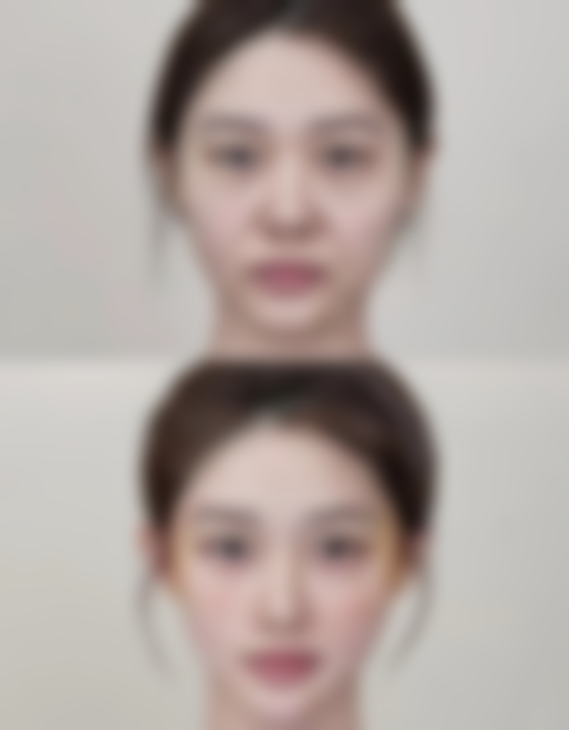 打了除皱针后多久可以敷医用面膜