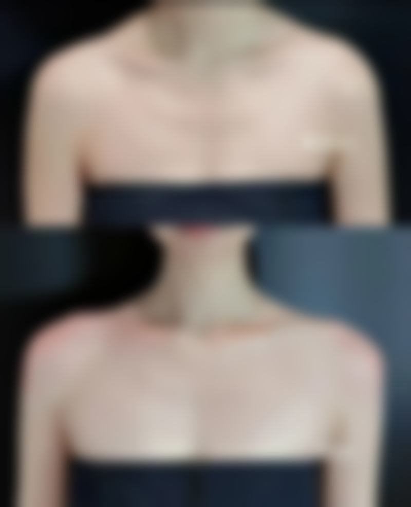 适合瘦脸针的常见特征