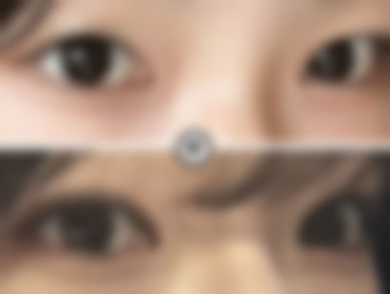 自体脂肪丰臀效果能维持多久？专家揭秘：正常可达5 - 10年，做好这些能让效果更持久！ 