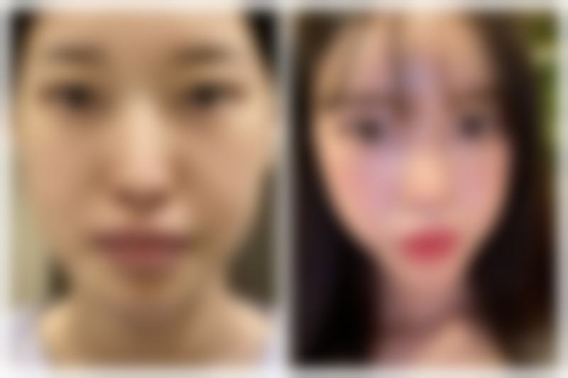 做阴道紧缩术需要休息多久