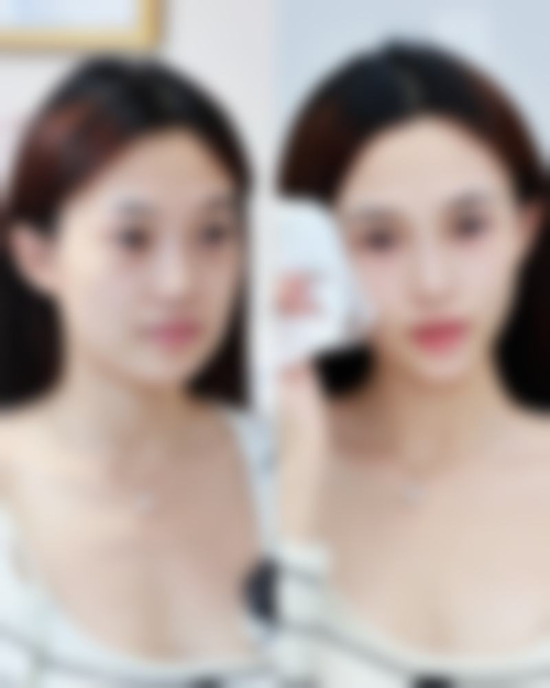 不同品牌瘦脸针的特点对比