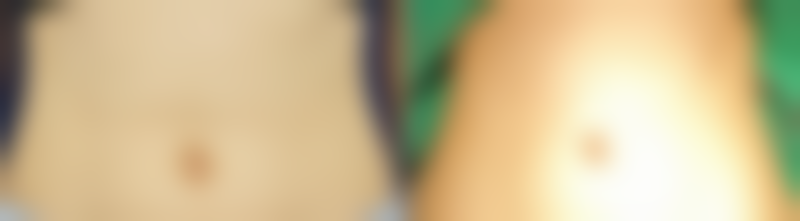 做阴道紧缩术疼吗