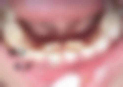 手部去皱纹手术