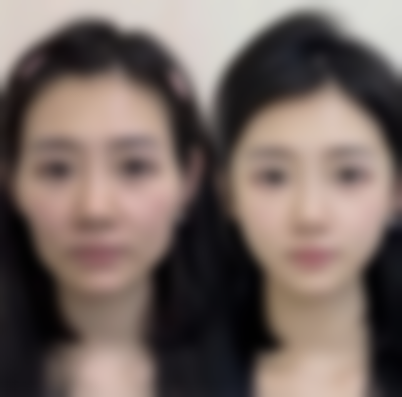 手部除皱整形是恒久的吗