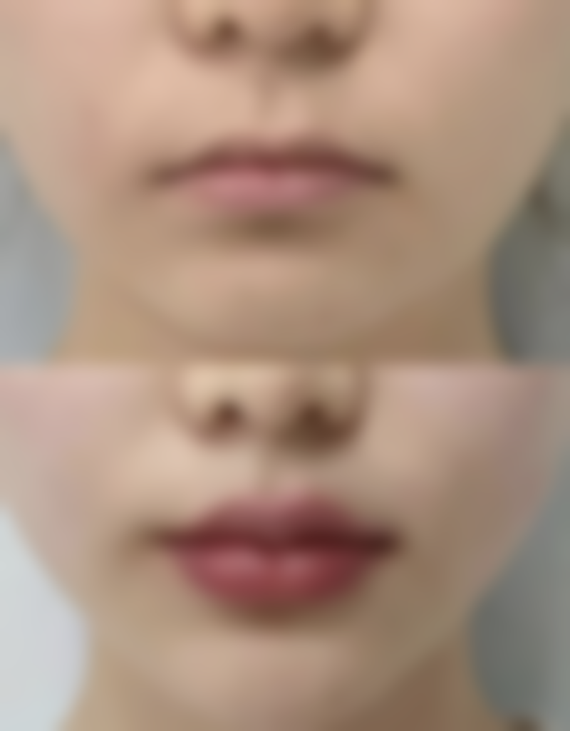 瘦脸针能否通过定期注射维持恒久成效