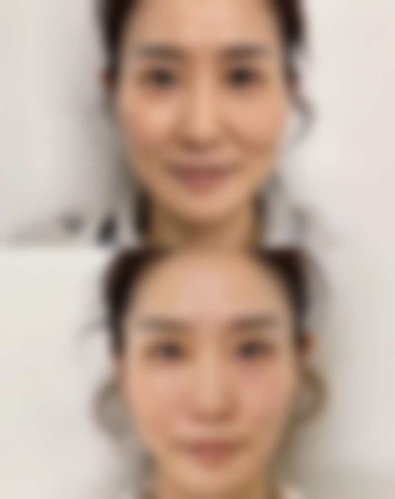 瘦脸针是需要长期打吗？揭秘瘦脸针长期注射真相，3大优势让你告别“大饼脸”实现精致小V脸！ 