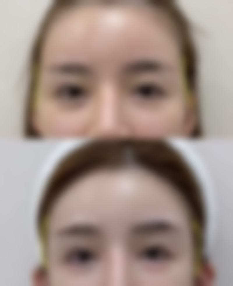 美白针能维持多久,过了会反弹吗