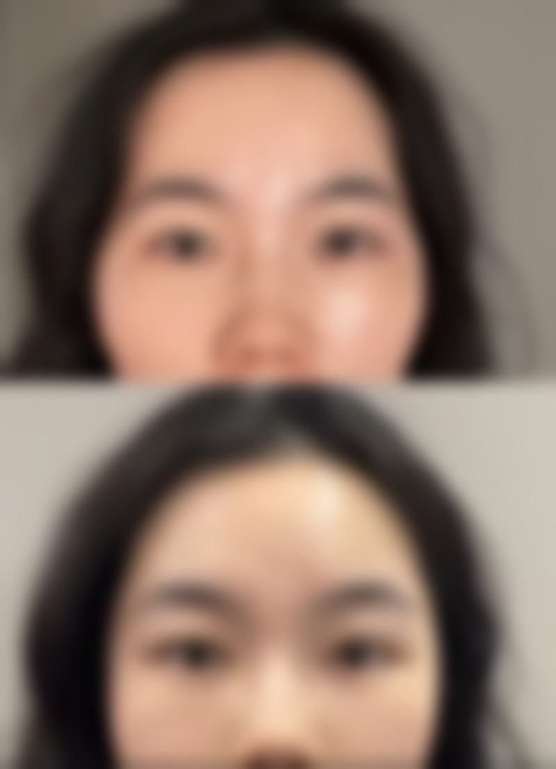 手部除皱针成效