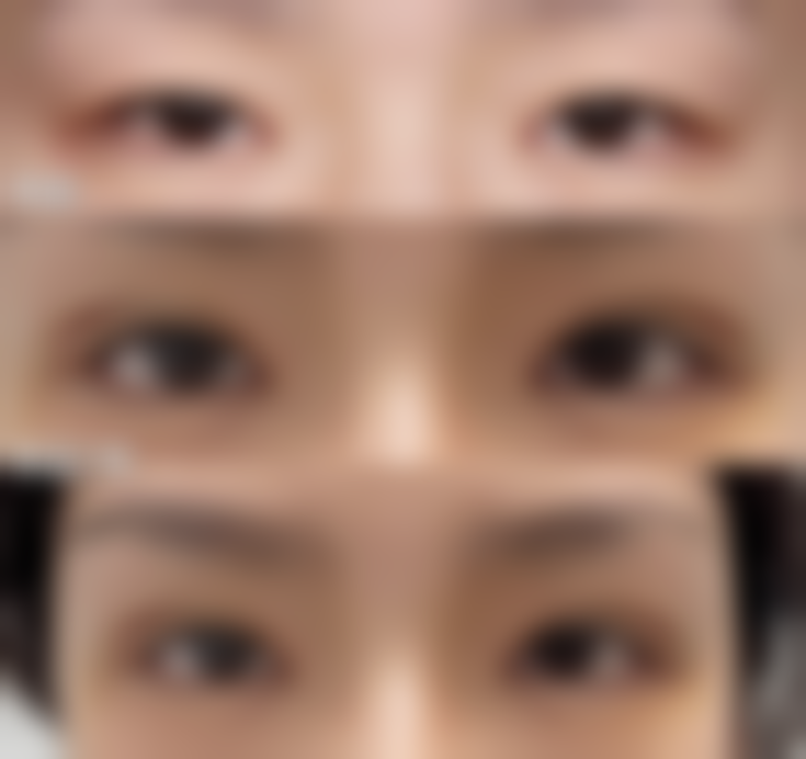 打完瘦脸针多久吃东西不会酸痛