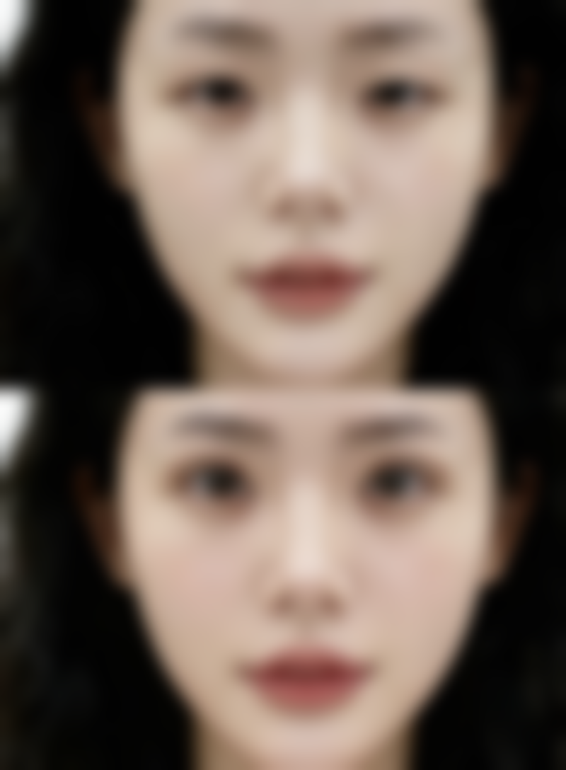 瘦脸针加轮廓针