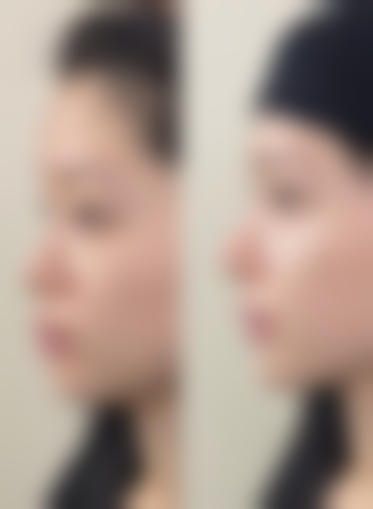 美白针美白成效好不好