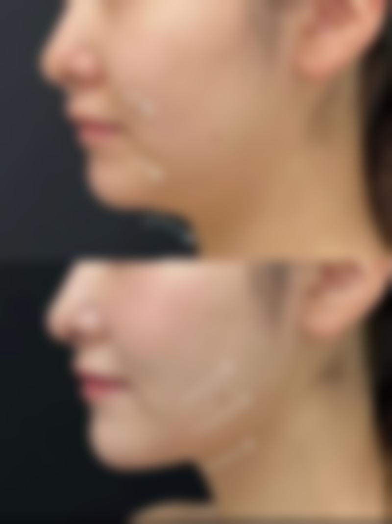 打瘦脸针需要注意什么