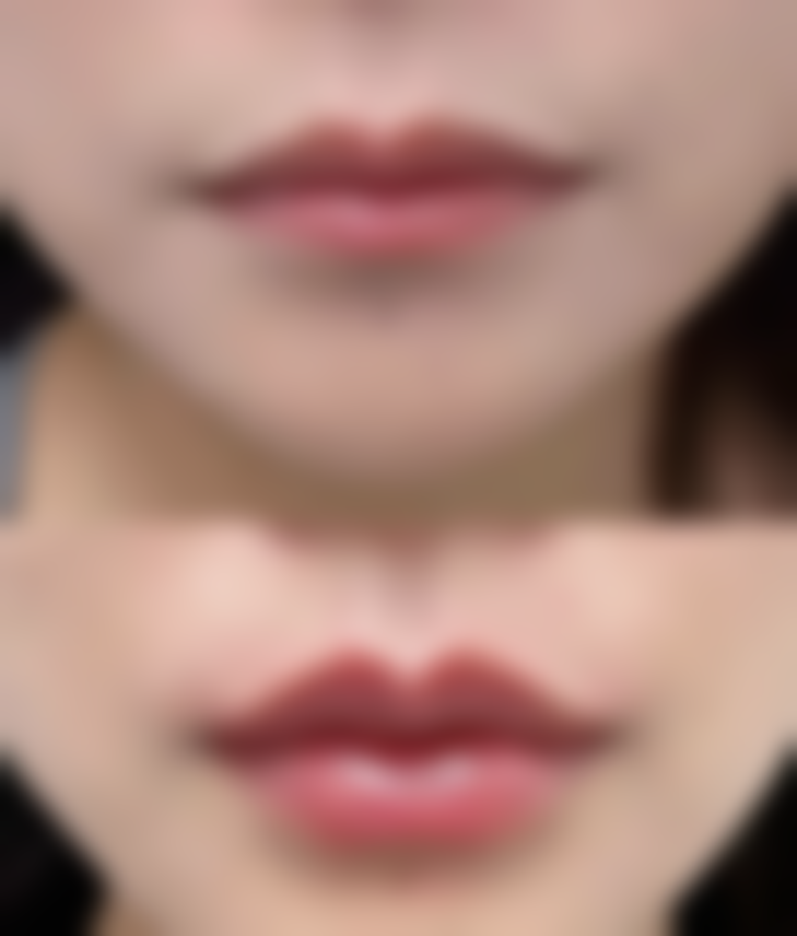 瘦脸针治疗后的注意事项