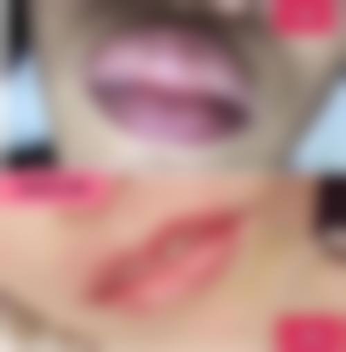 自体脂肪移植丰太阳穴的价格