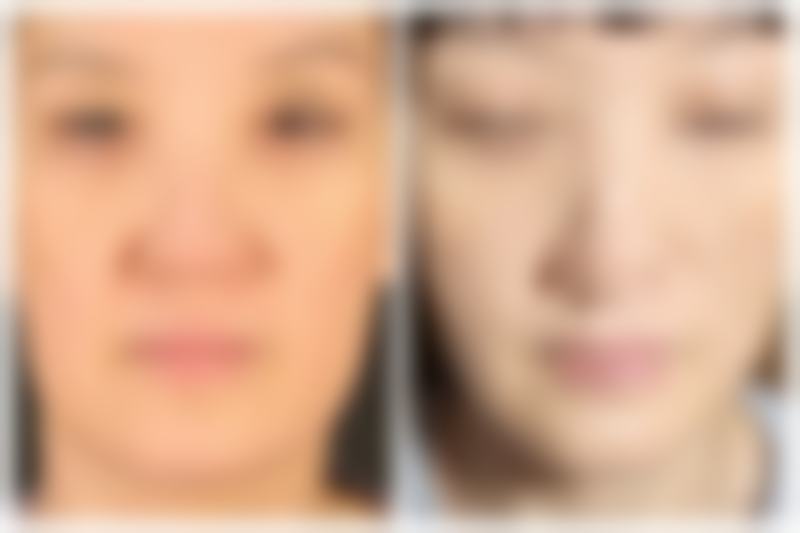 瘦脸针的价格情况