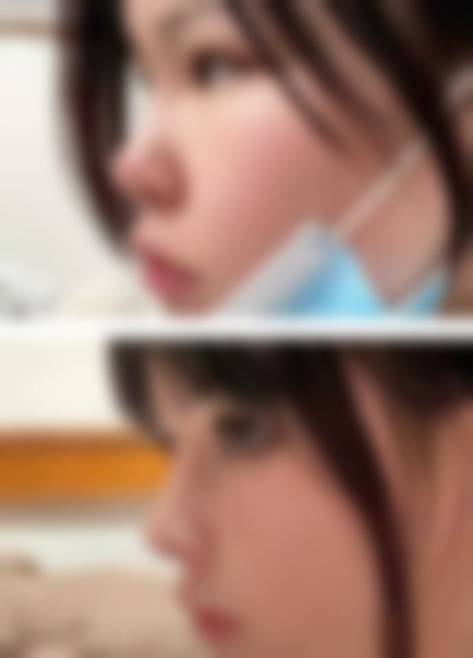 瘦脸针打一次可以完全修复吗