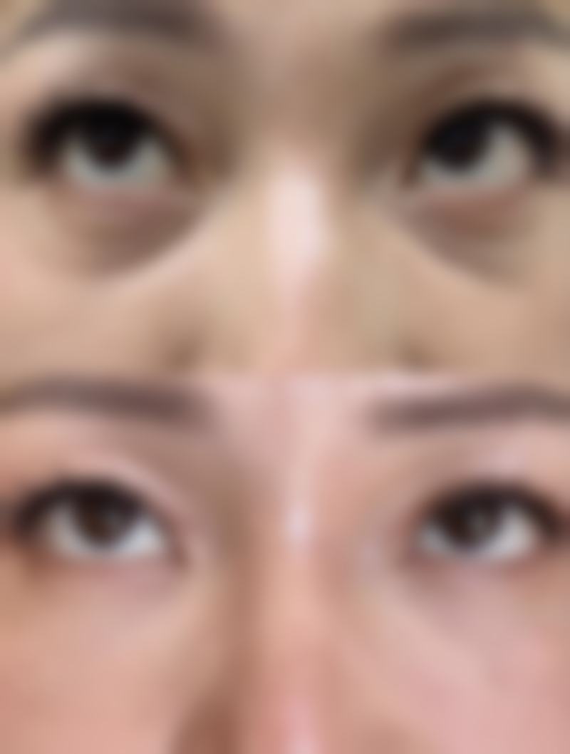 毛囊种植后多长时间稳固