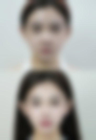 自体脂肪移植丰太阳穴的修复过程和注意事项