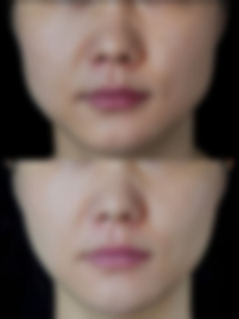 打完瘦脸针后嘴巴歪了