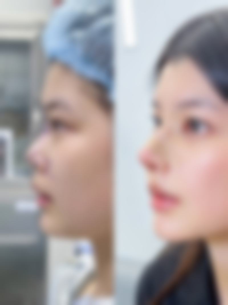 面上中1/3皮肤松弛面部除皱术式选择