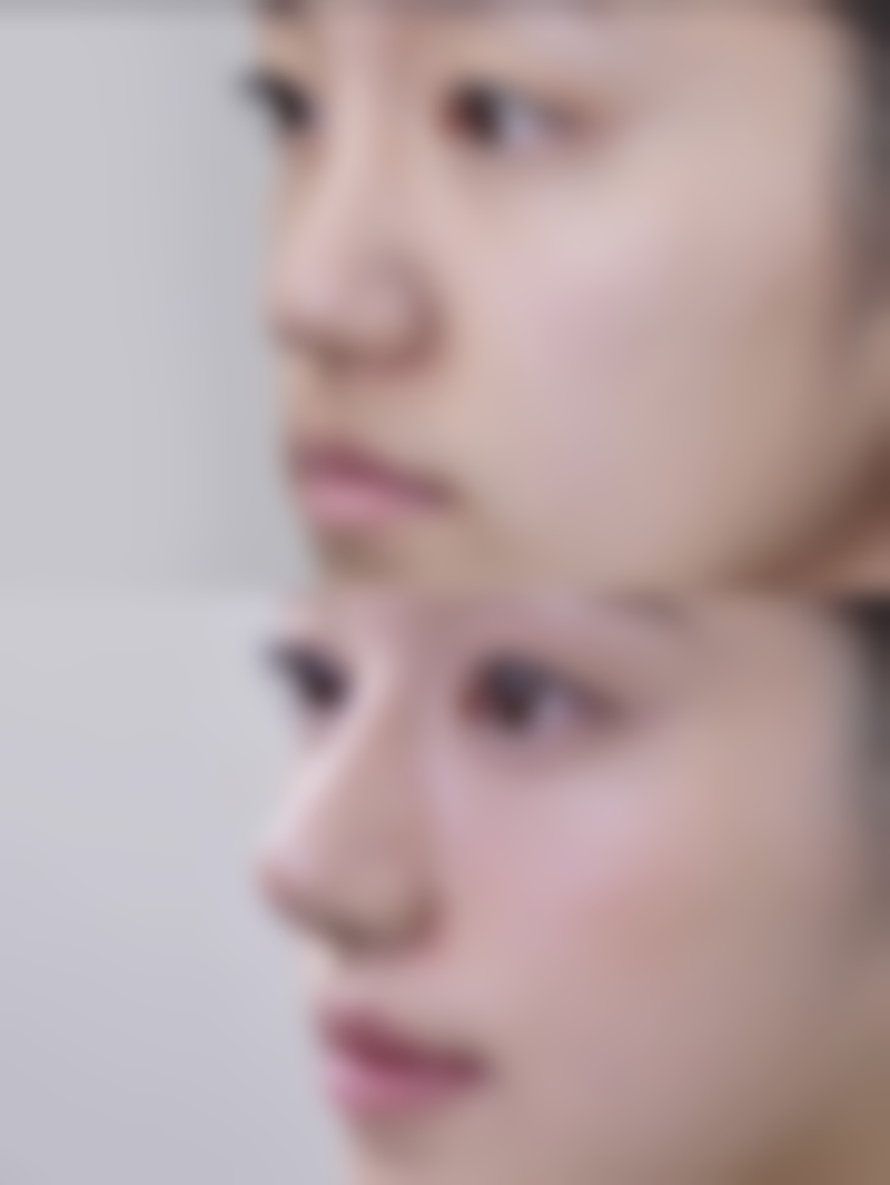 打完瘦脸针脸颊凹陷能修复到以前的样子吗