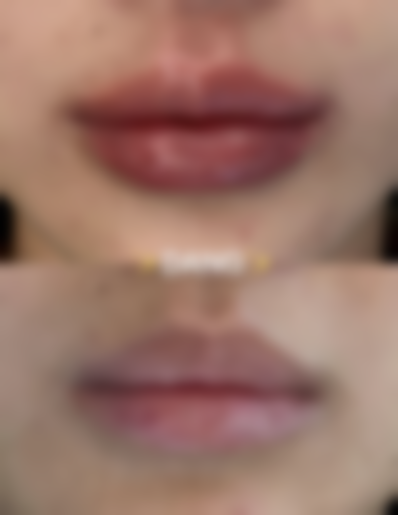 瘦脸针多久打一次成效至佳