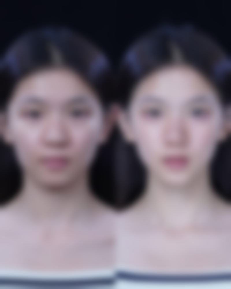 打瘦脸针多长时间可以洗脸