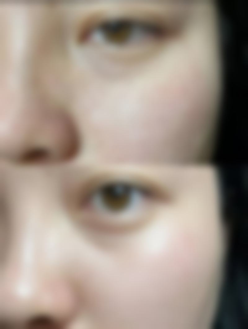 打瘦脸针多长时间修复原样