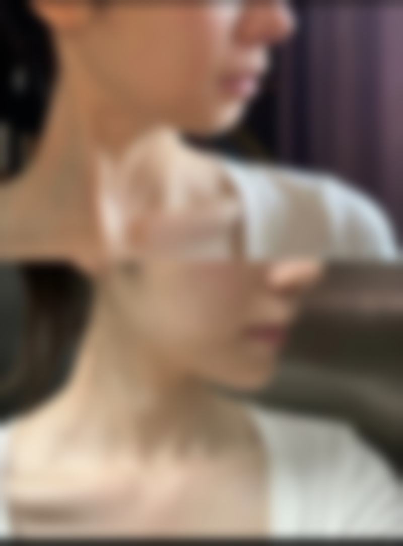 打瘦脸针多长时间可以怀孕