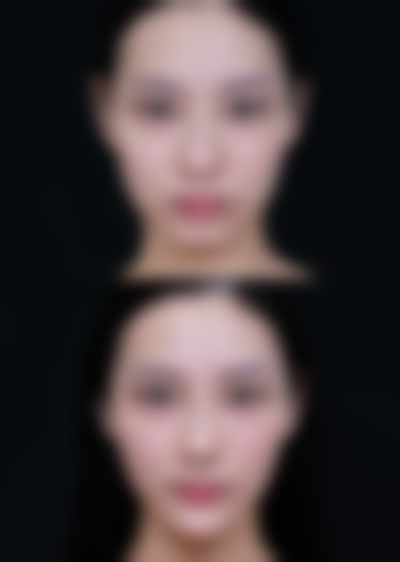 头发种植的过程