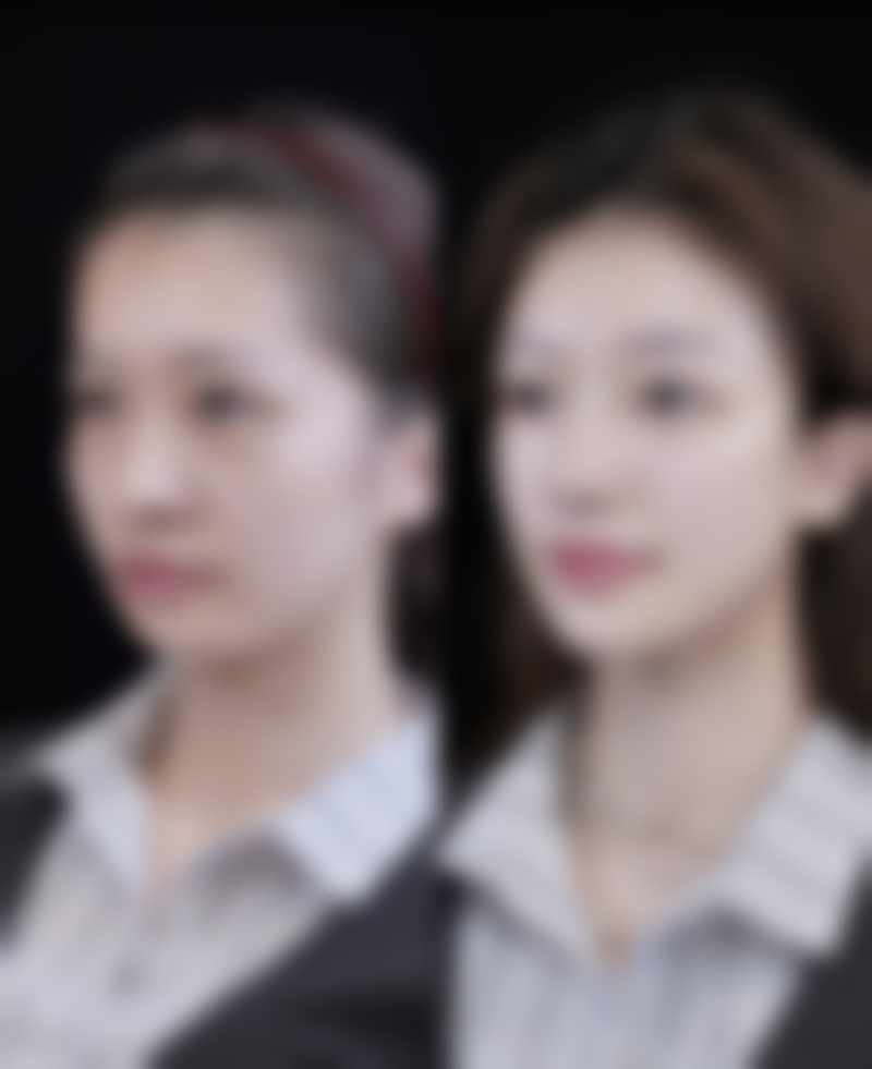 种植头发的危害和后遗症