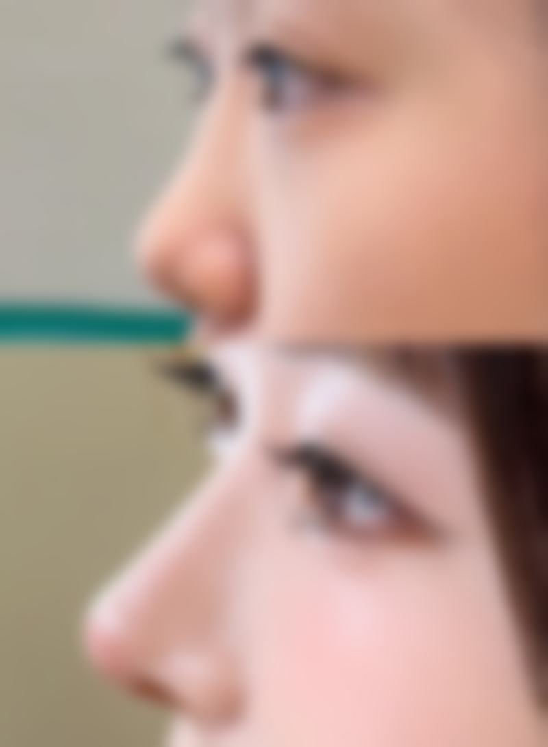 如何选择合适的瘦脸针治疗