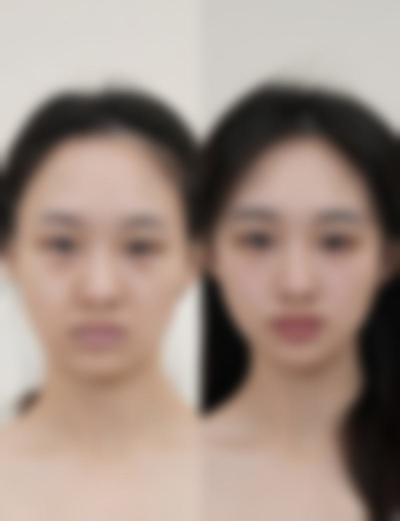 方脸打瘦脸针管用吗