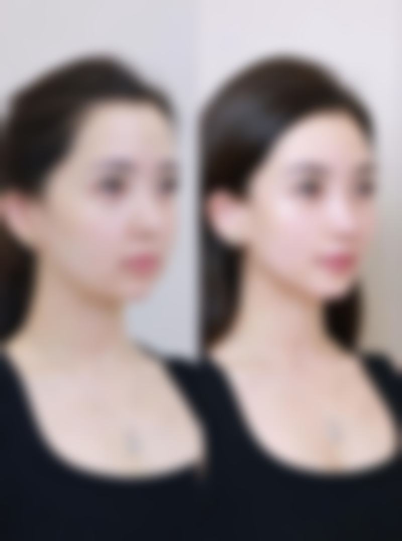 方脸打了瘦脸针是什么脸型