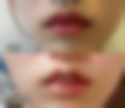 打保妥适瘦脸针多少钱一针