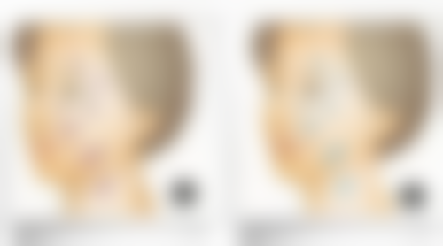 瘦脸针瘦脸针打一针可以吗？权威揭秘一针瘦脸的效果、维持时间及适用人群！ 