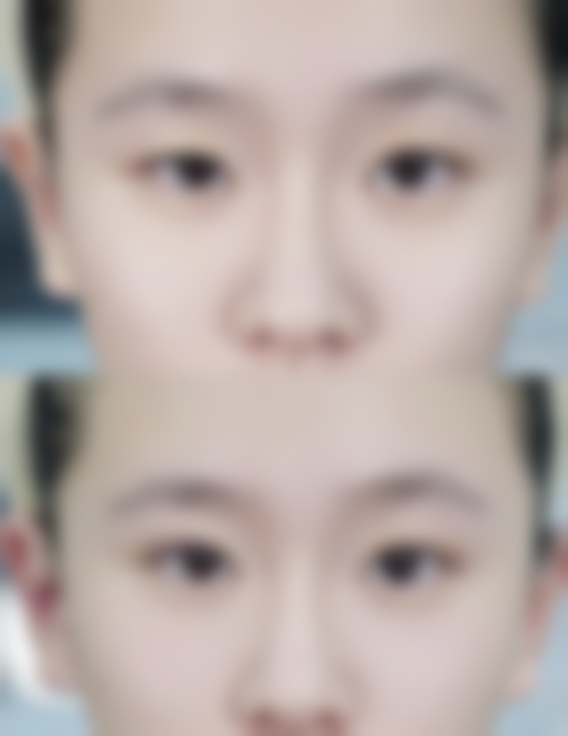 瘦脸针一般打50单位还是100单位