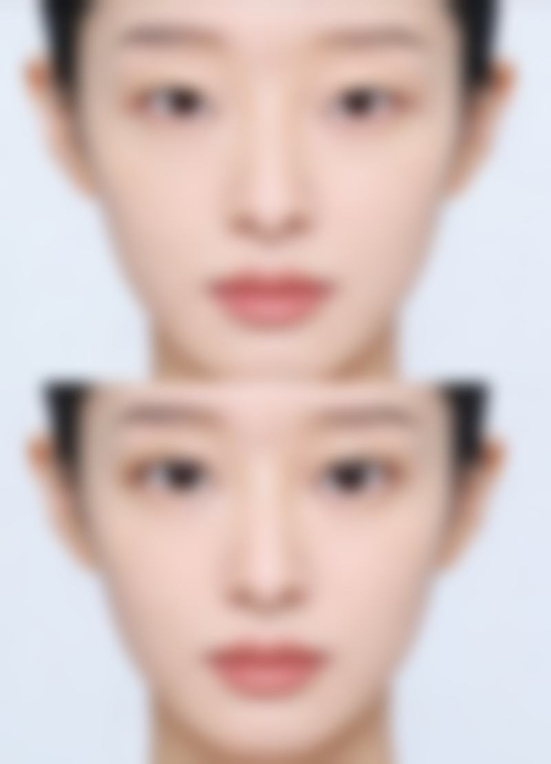 保妥适瘦脸针多少钱保妥适