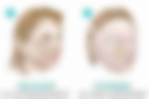 美白针打快了会怎样？速解危害，明辨疼痛、过敏等4大风险，开启美白安全变美之路！ 