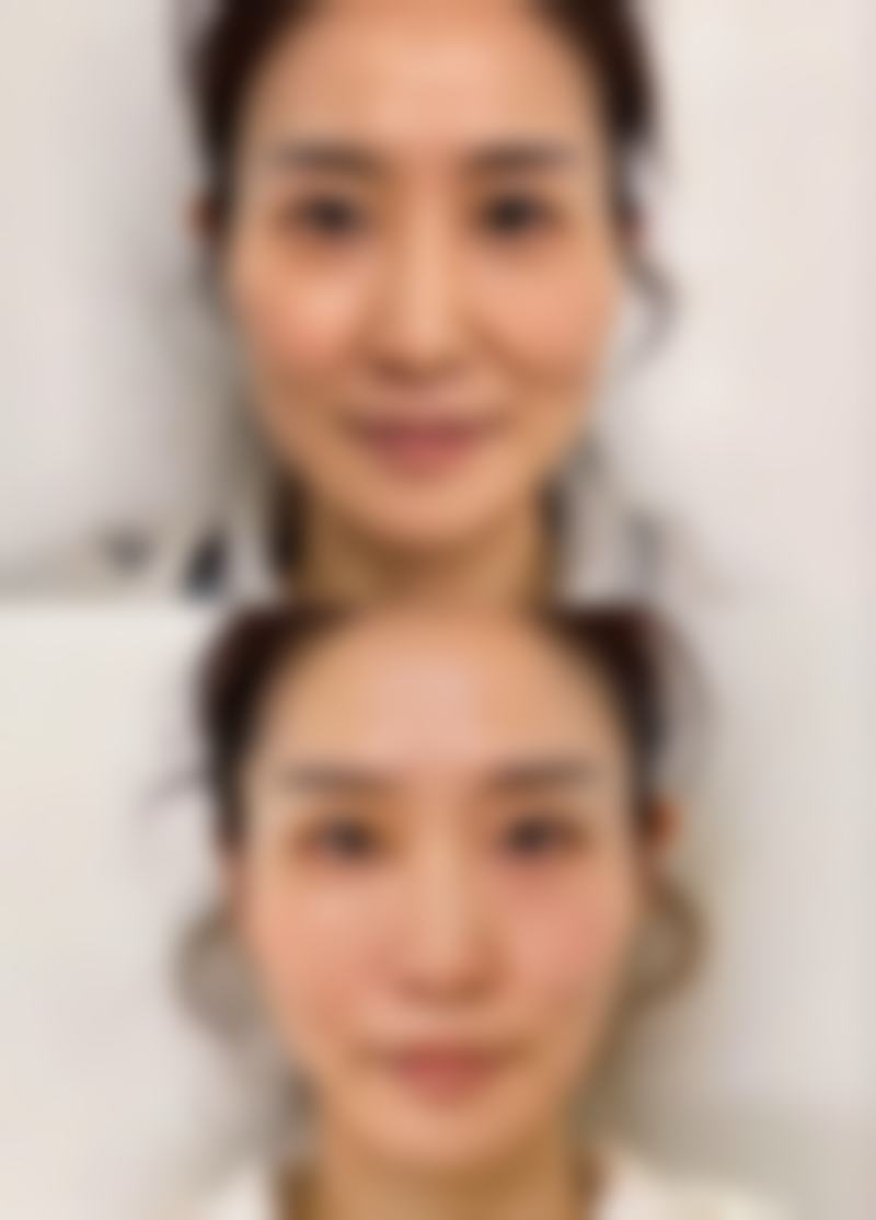 除皱可以保持多久？揭秘医美除皱效果持久秘诀，掌握这些方法让你的年轻状态多维持3 - 5年！ 