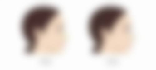 打除皱针脸僵肯定能修复吗