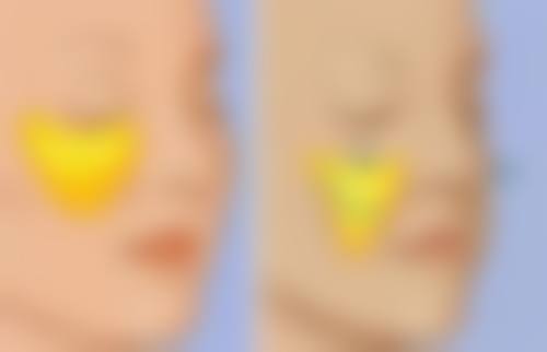 打完除皱针脸僵的原因