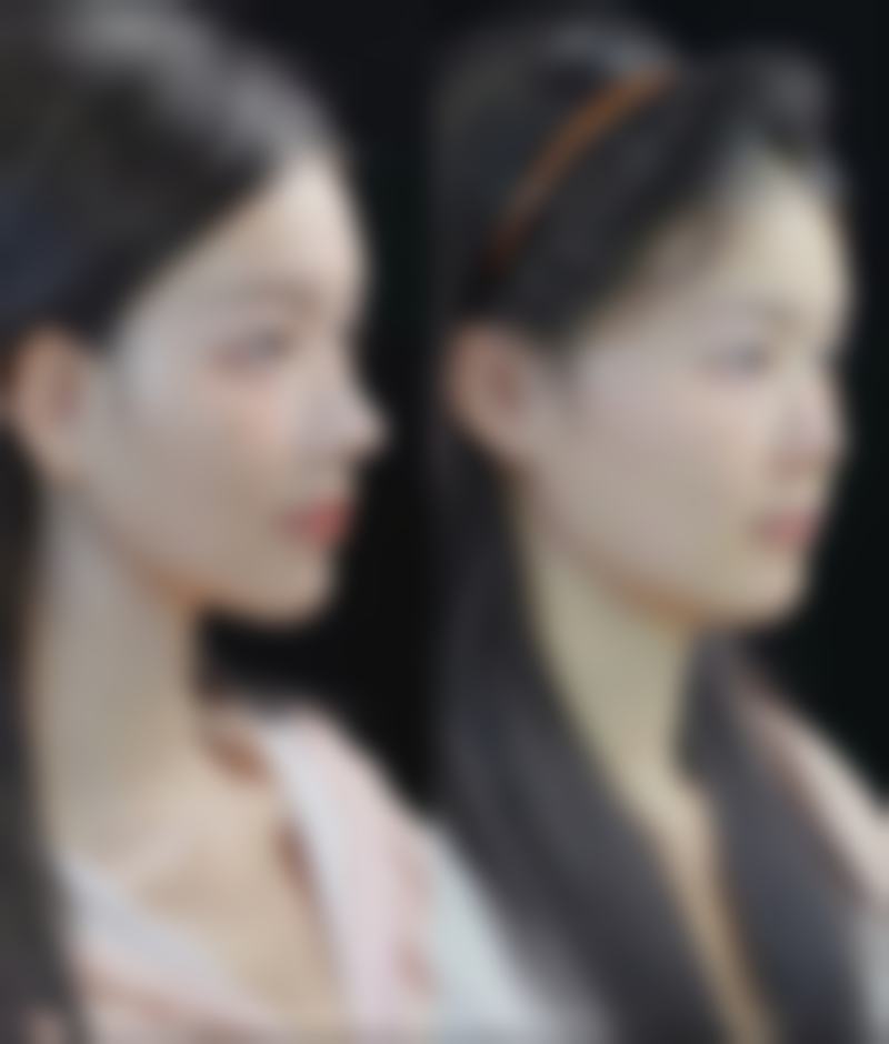 打完除皱针脸僵硬会有后遗症吗