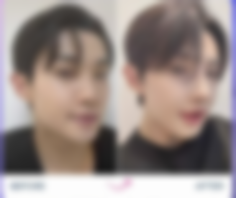 打了瘦脸针会反弹吗