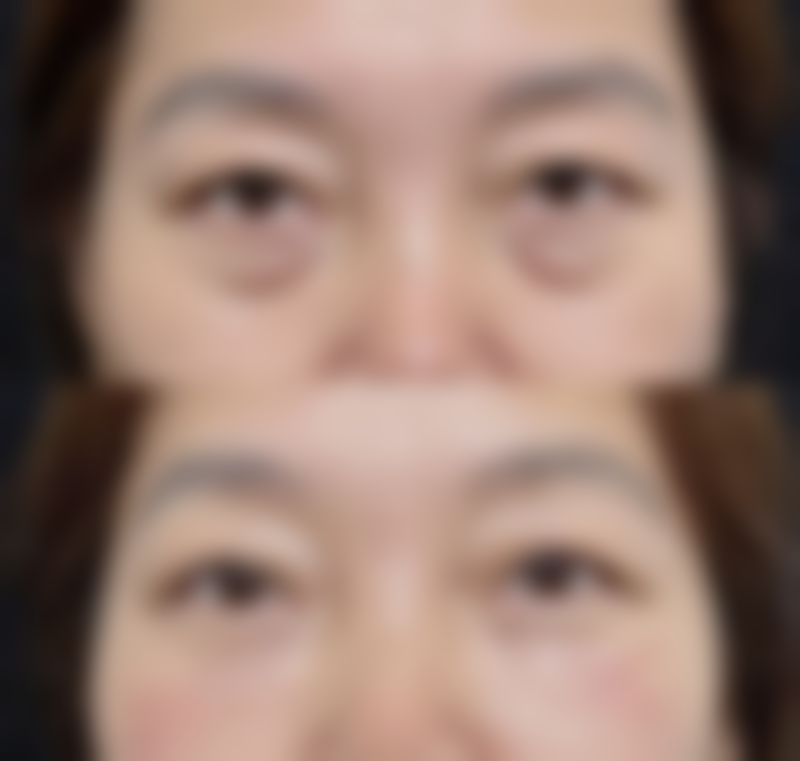 下颚骨发育不良怎么矫正