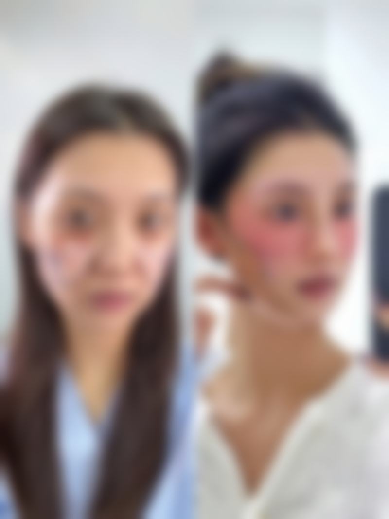 瘦脸针打了没有成效是什么原因