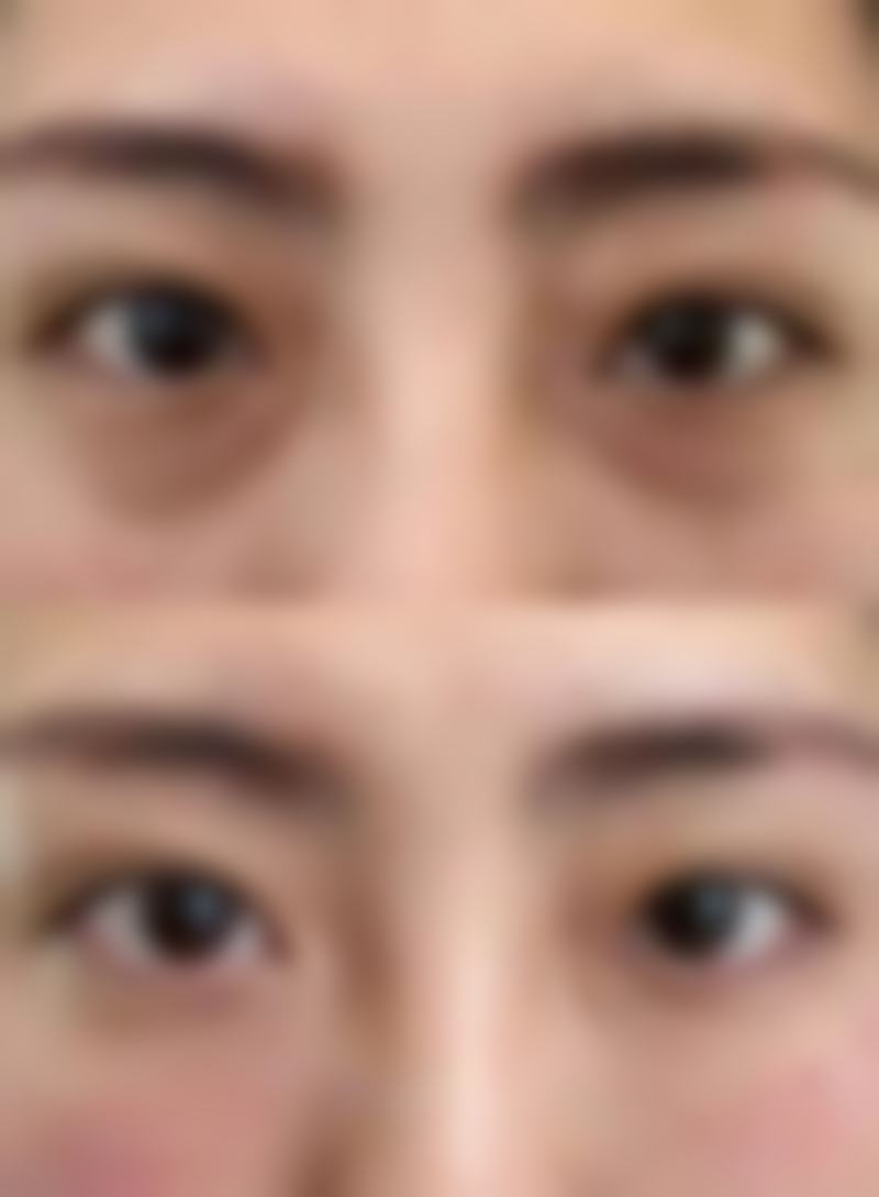 方脸能打瘦脸针吗