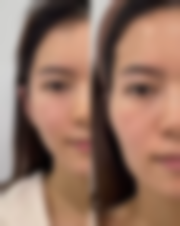 瘦脸针打了没啥成效