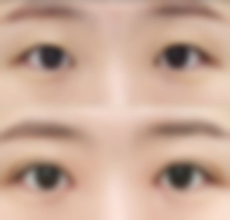 打了瘦脸针为啥没成效