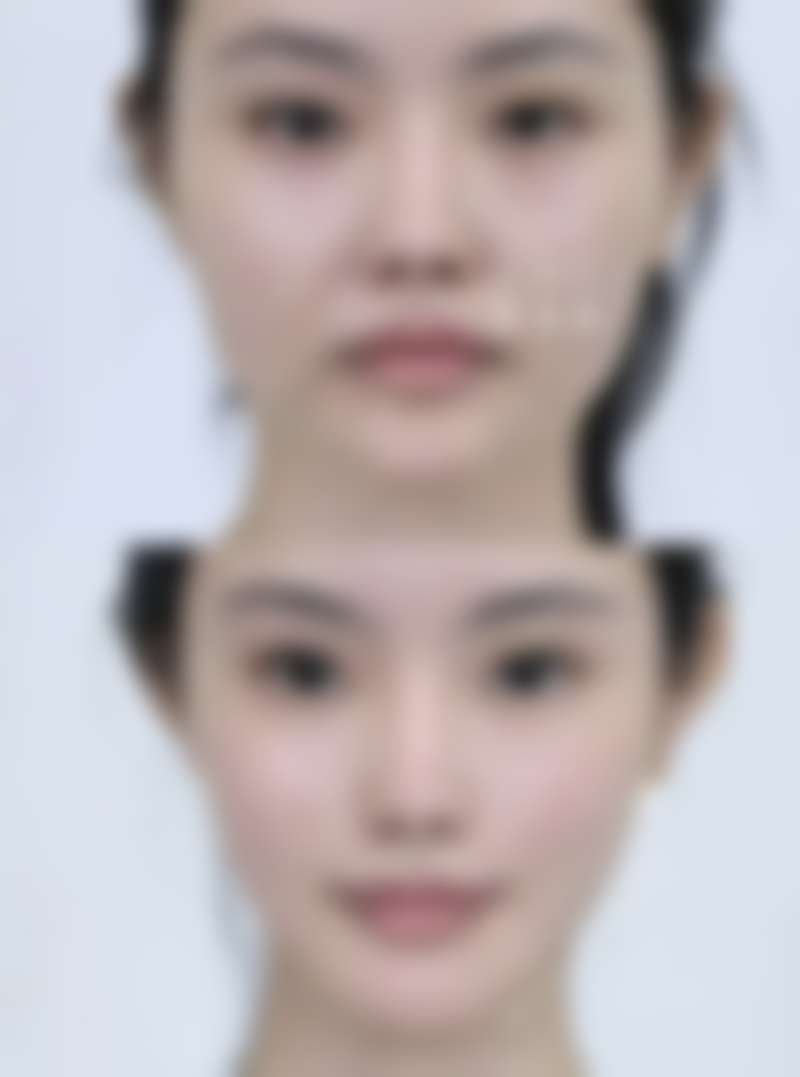 方脸适合打什么样的下巴